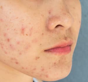 Acne Targeting
