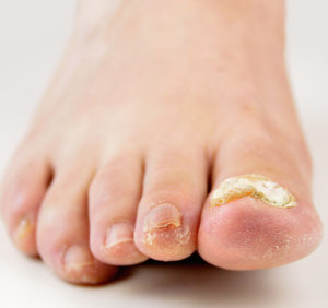Fungal Infection Targeting