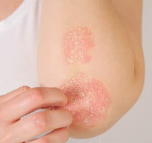 Eczema Targeting
