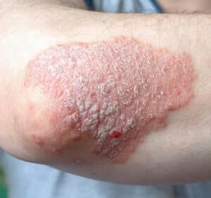 Psoriasis Targeting