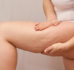 Cellulite Targeting