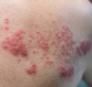 Shingles Targeting