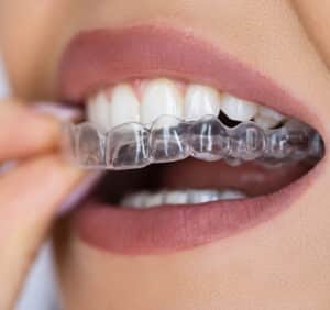 Clear Dental Aligner