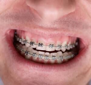 Orthodontic Braces