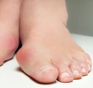 Bunions Targeting