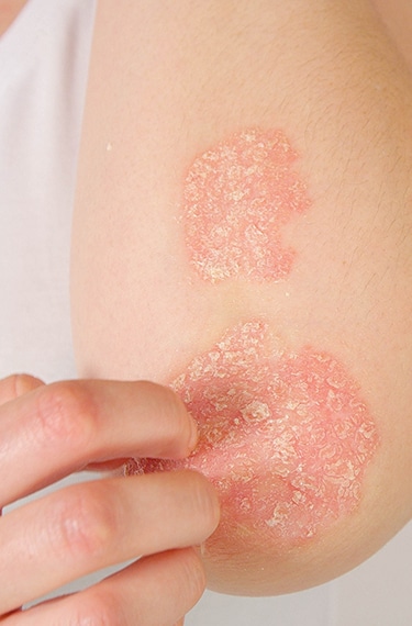 Allergy Targeting Rash