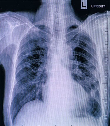 Pulmonologists Targeting - Lung Xray