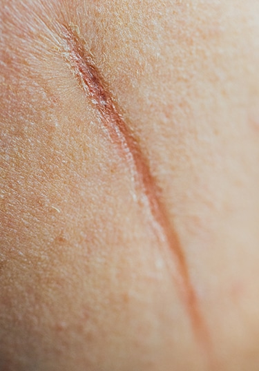 Scar on Skin